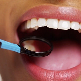 Closeup of mouth being examined with dental mirror