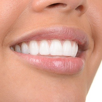 Close up of flawless smile with metal free dental restorations in Dallas