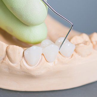 Dentist designing a dental bridge to replace missing teeth in Dallas