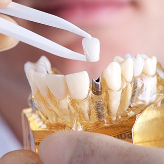 Dentist placing a dental crown on a dental implant model