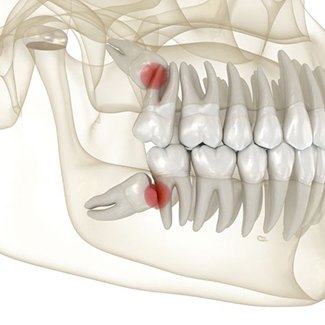 Dental X-ray with wisdom teeth highlighted in red