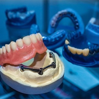 Example of implanted dentures from Del Rey Dental