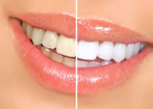 Closeup of a smile that's halved to show before/after teeth whitening results