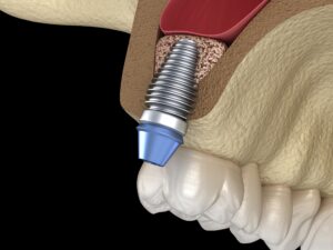 Implant post inserted into upper jaw