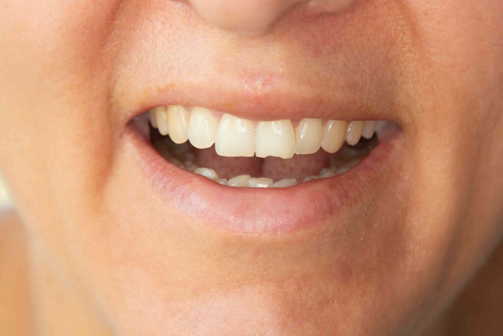 Person with a chipped tooth